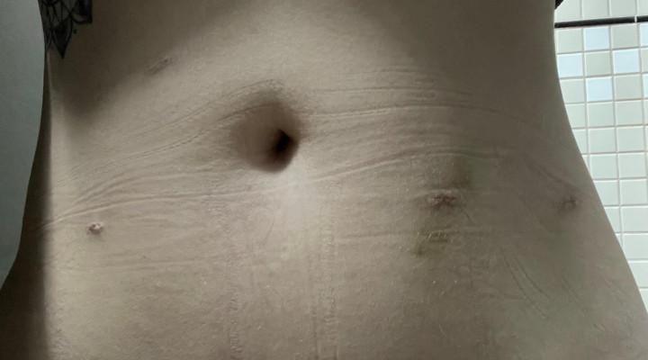 Endometriosis - My scars