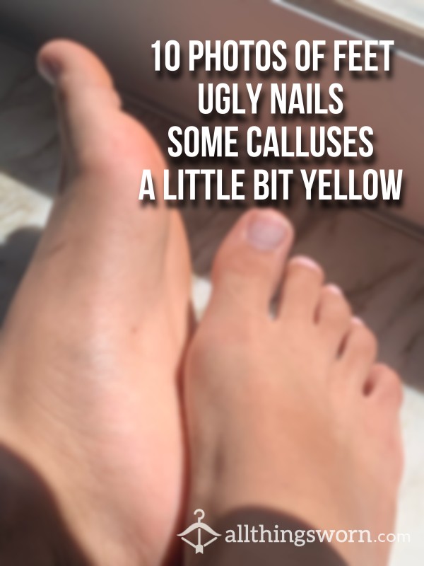 10 Photos | Ugly Nails | Little Calluses