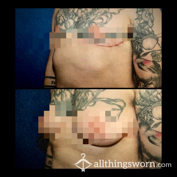 5 Before And After Comparisons | Top Surgery | 10 Photos Total