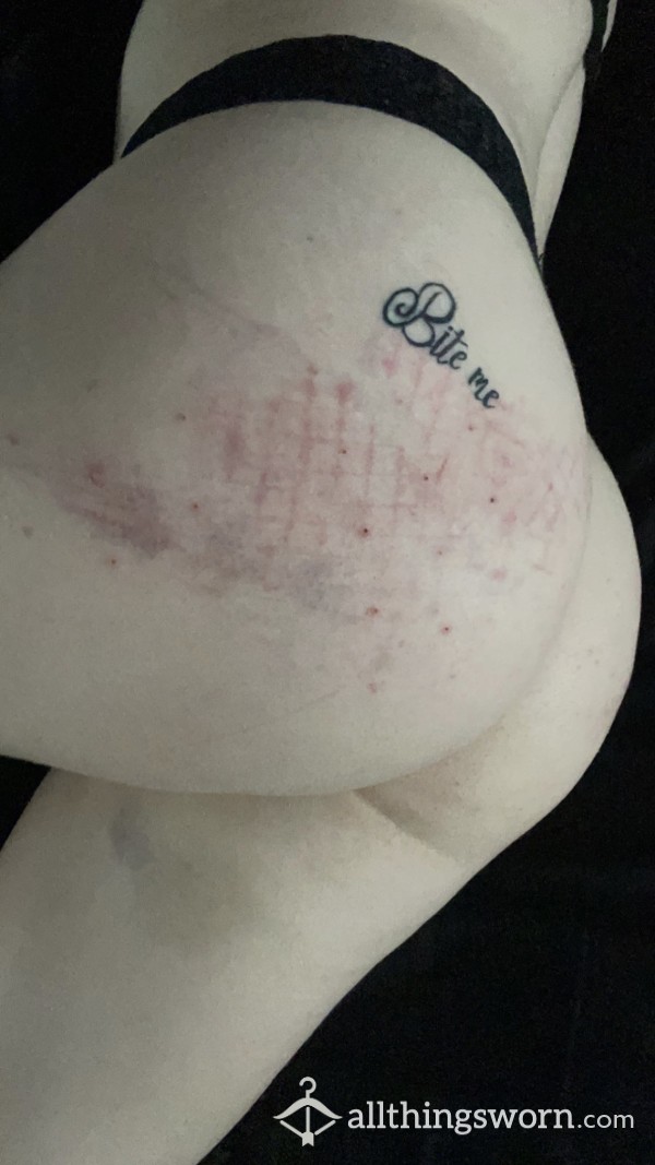 Ass Bruising, Marks From Impact Play 🔥
