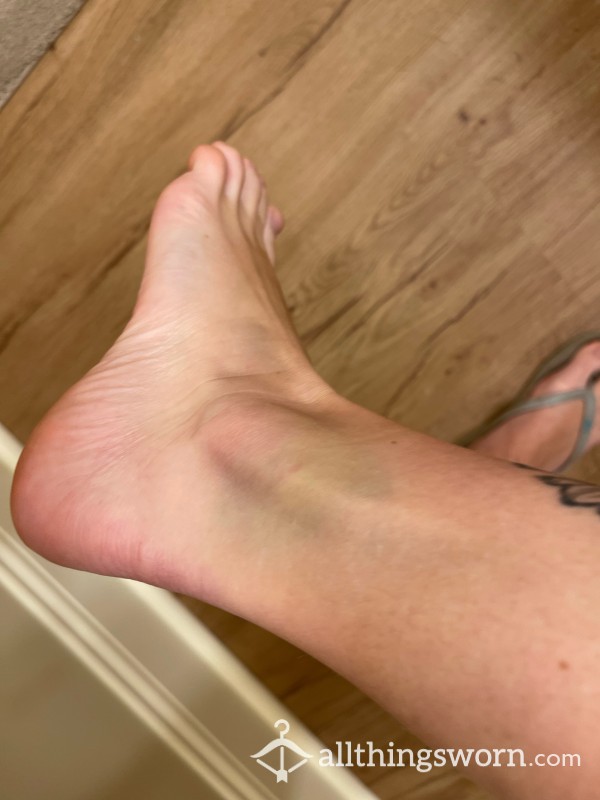 Feet Bruises/injuries