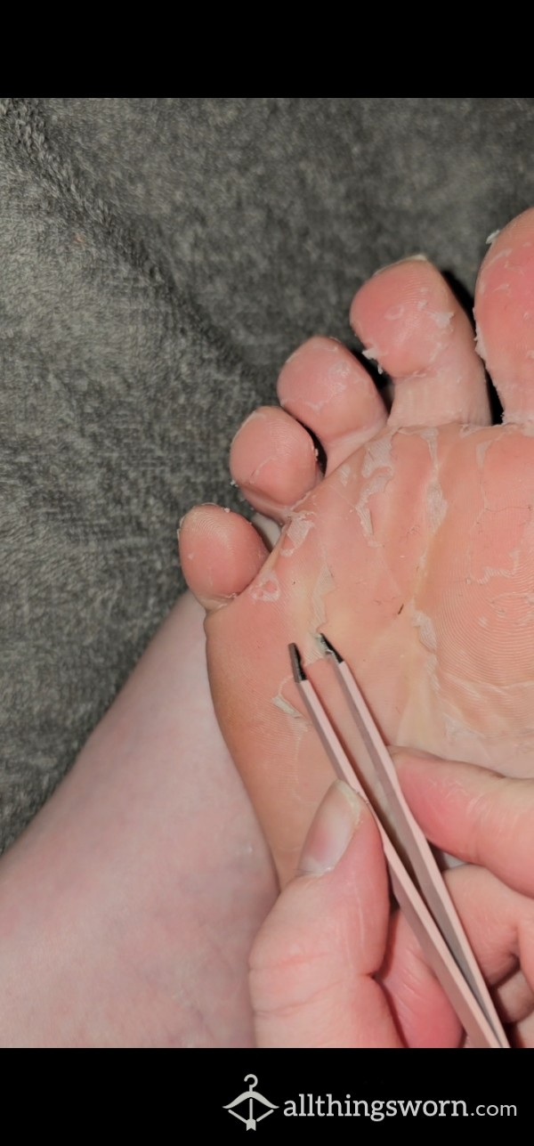 Feet Skin Peel