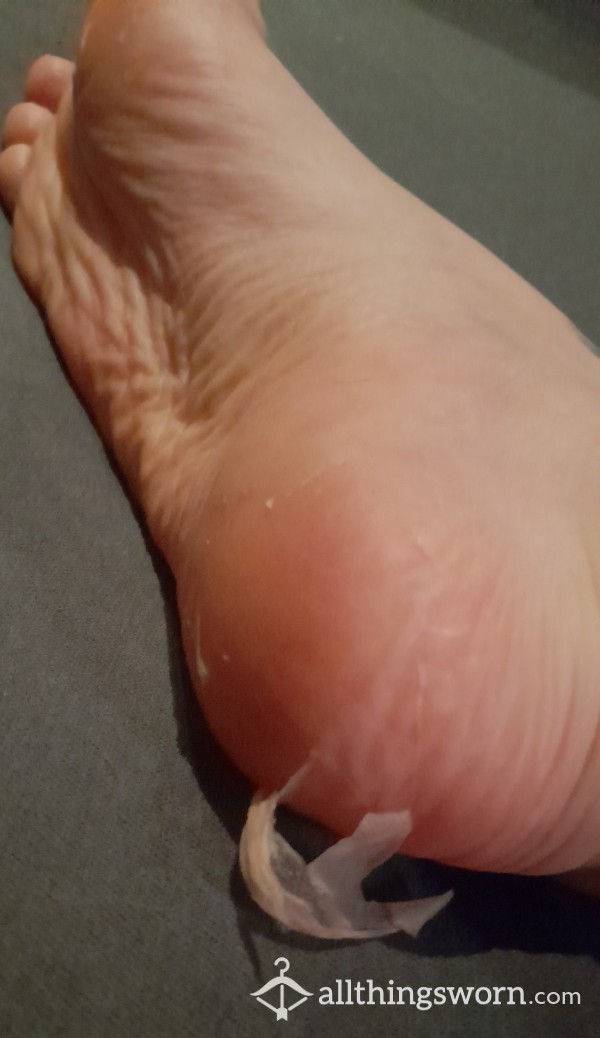 Foot Skin Peel Treatment