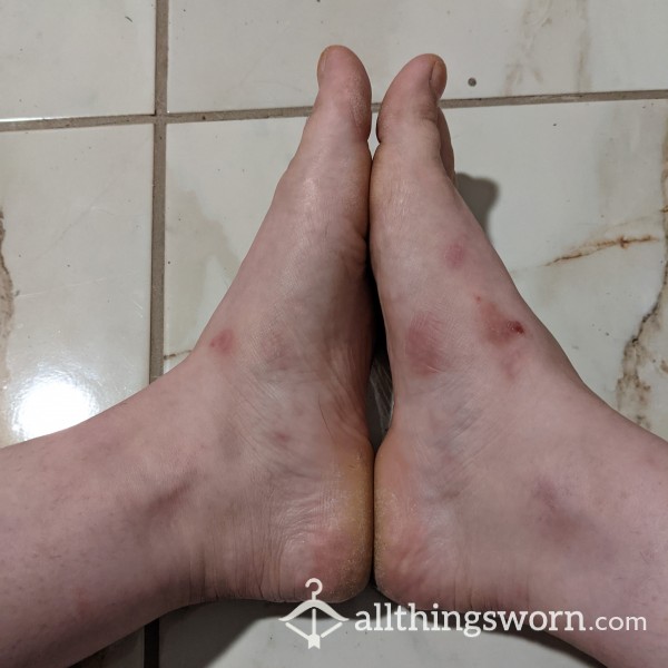 Gross Runners Feet Foot Peel Photo Spread