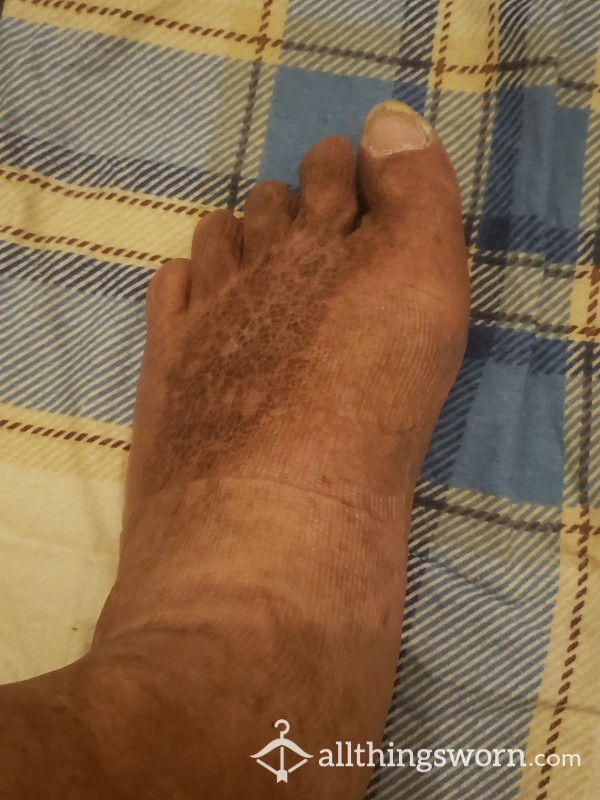 Lymphedema Scars & Discoloration