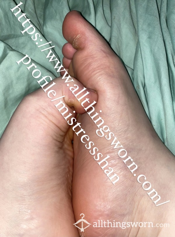 Photo Set- Calloused Feet