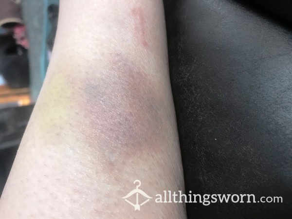 Pictures Of My Rough Play Bruises