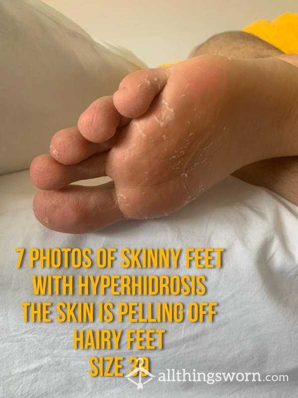 Ugly Feet With Hyperhidrosis | Peeling Off | Size 9| Hairy Feet